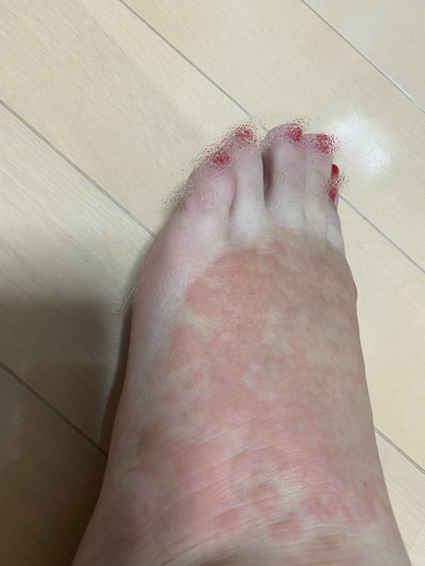 足の湿疹②